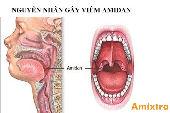 Nguyen nhan gay viem amidan